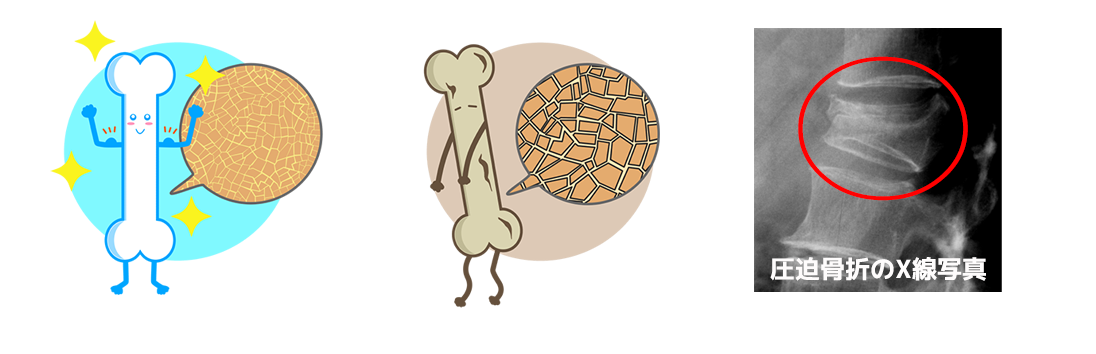 骨粗鬆症のイメージ